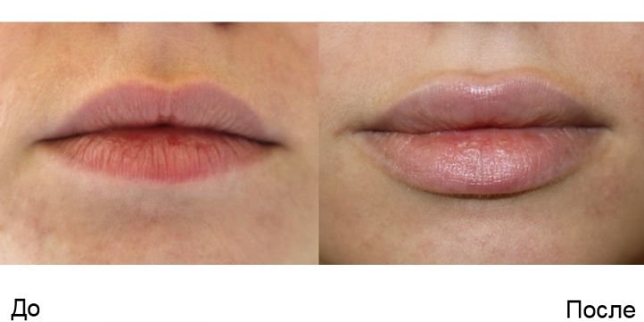 Увеличение губ гиалуроновой кислотой - фото до и после