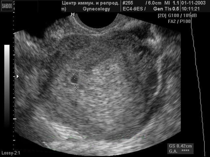 Фото Эмбриона На 1 Неделе Беременности