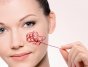 Способы лечения купероза на лице